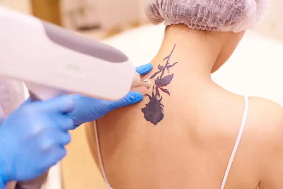 Laser Tattoo Removal by MEADOW SURGICAL ARTS S Corp in Commerce, GA