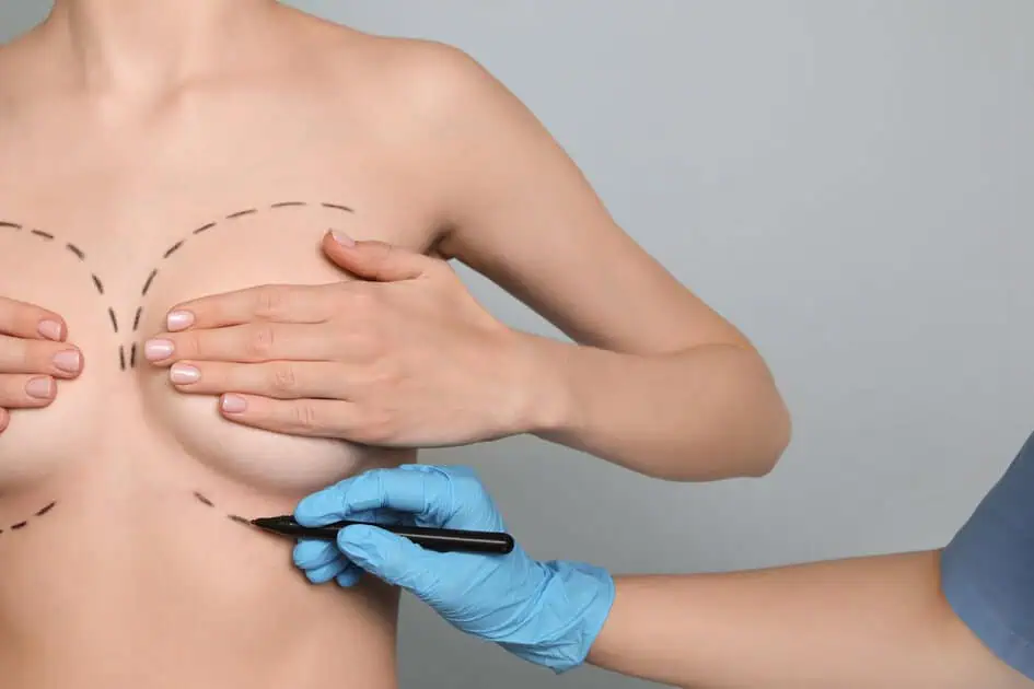 Breast Lift by MEADOW SURGICAL ARTS S Corp in Commerce, GA