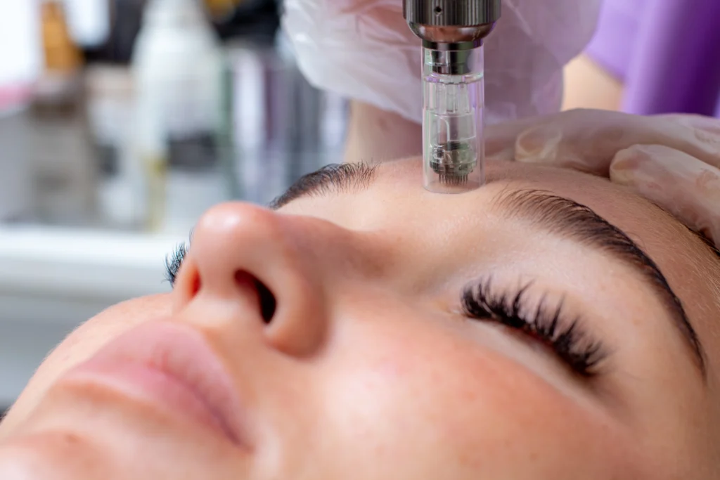Microneedling in Georgia at Meadows Surgical Arts
