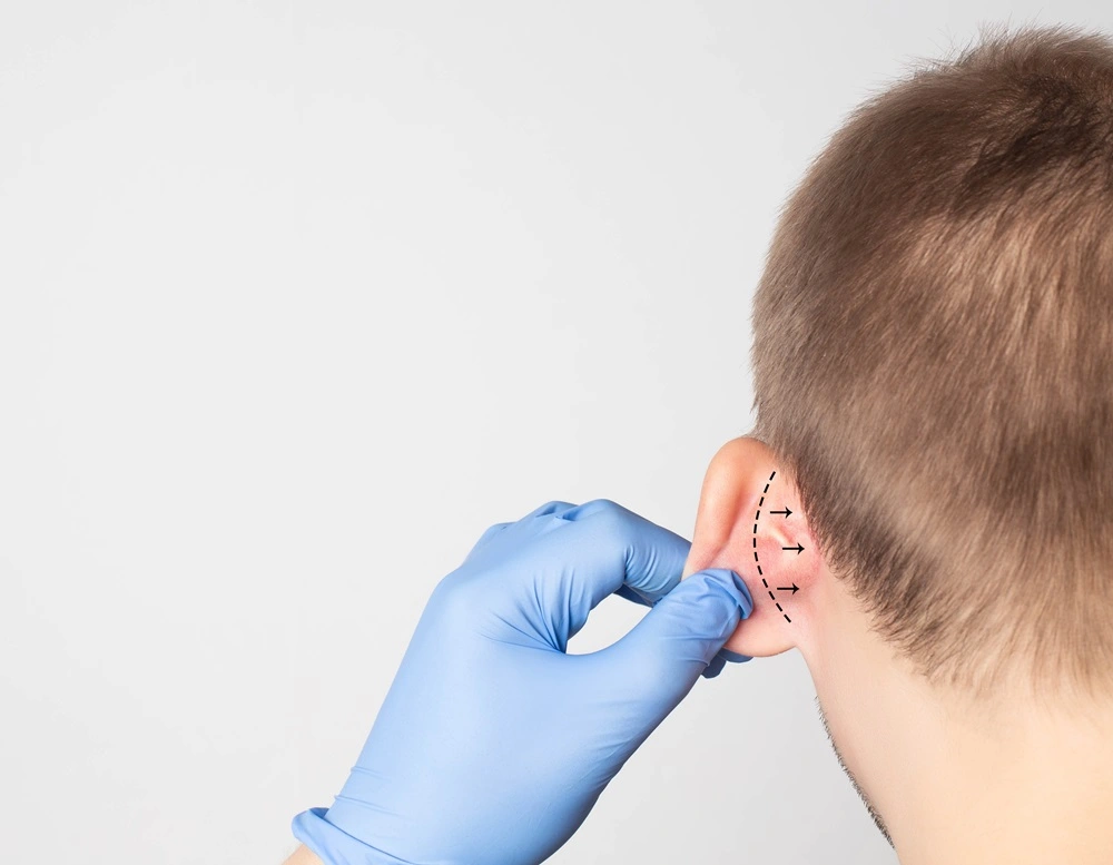 Ear Surgery (Otoplasty) in Georgia at Meadows Surgical Arts