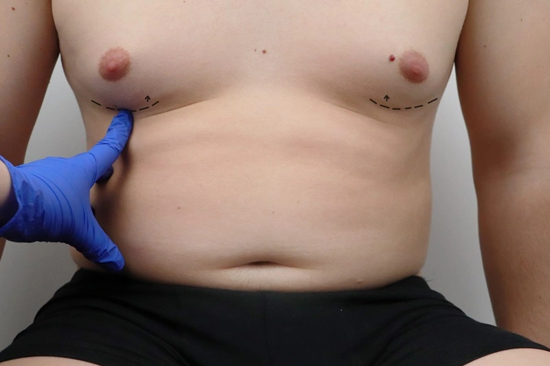 male breast reduction at Meadows Surgical Arts in Georgia