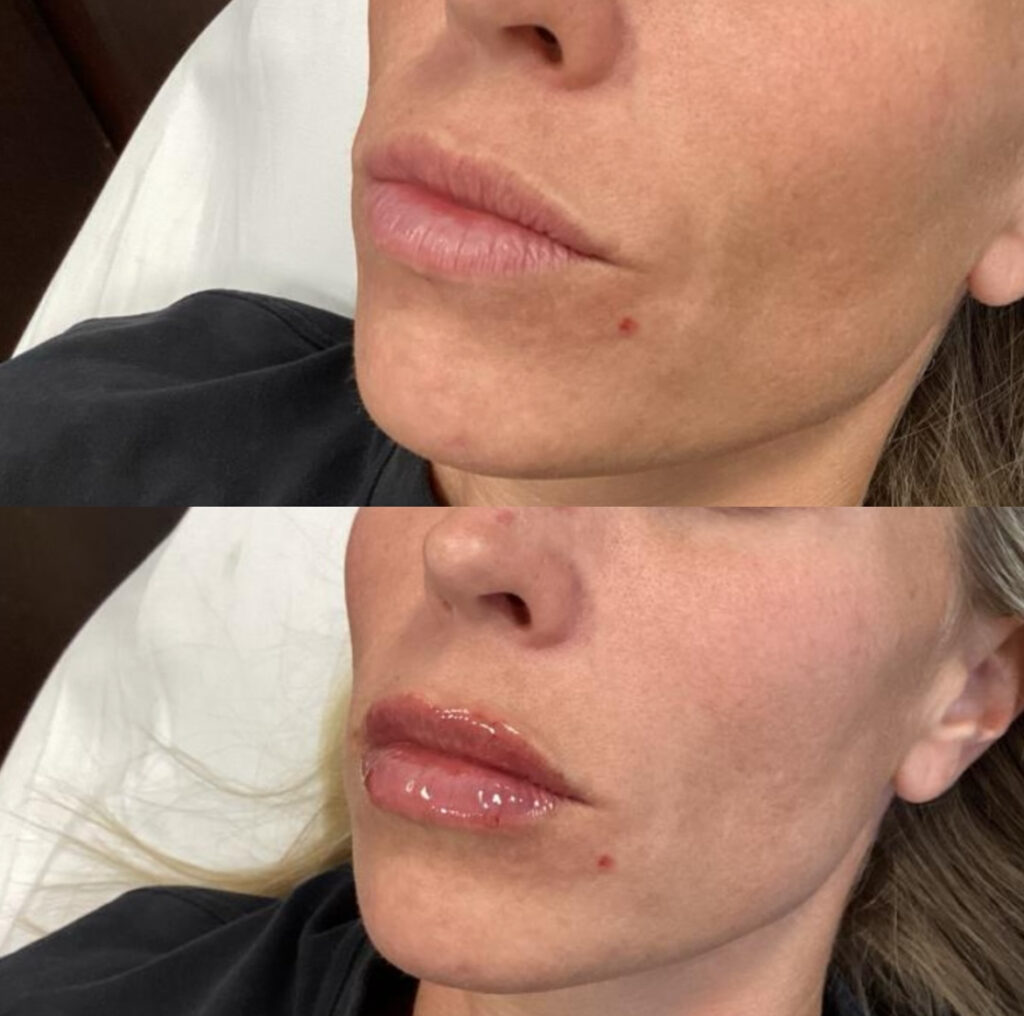 Lip Surgery at Meadows Surgical Arts in Georgia