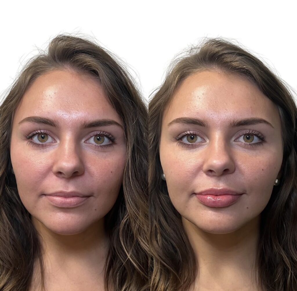 Lip Surgery at Meadows Surgical Arts in Georgia