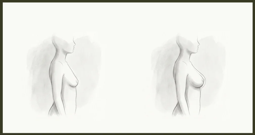 Breast Augmentation Results: What Real Transformations Look Like