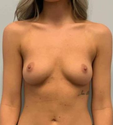 Breast Lift in Georgia at Meadows Surgical Arts