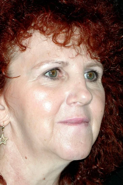 Deep Plane Total Facial Rejuvenation in Georgia at Meadows Surgical Arts