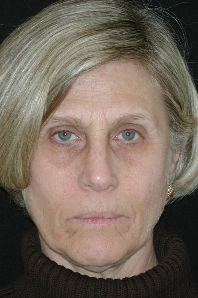 Deep Plane Facial Rejuvenation in Georgia at Meadows Surgical Arts