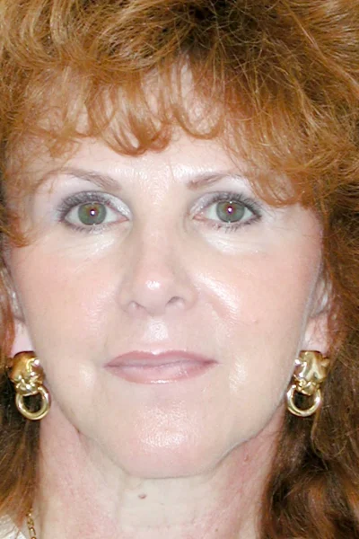 Deep Plane Total Facial Rejuvenation in Georgia at Meadows Surgical Arts