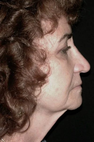 Preop Facial Rejuvenation & CO2 Laser Skin Resurfacing in Georgia at Meadows Surgical Arts