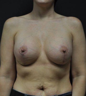 Breast Lift in Georgia at Meadows Surgical Arts