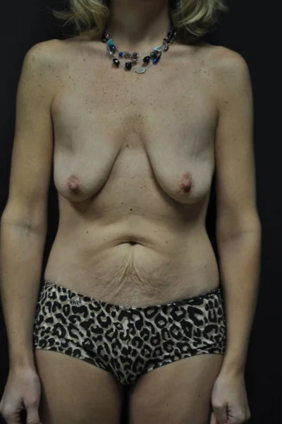 Breast Lift in Georgia at Meadows Surgical Arts