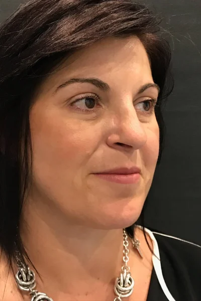 DrDaddyK Signature Neck Lift" with Renuvion in Georgia at Meadows Surgical Arts