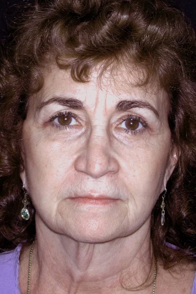 Preop Facial Rejuvenation & CO2 Laser Skin Resurfacing in Georgia at Meadows Surgical Arts