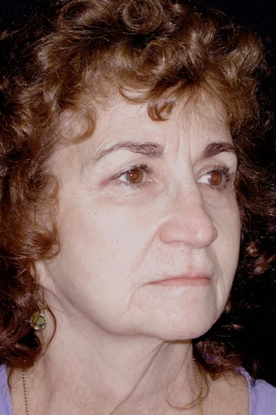 Deep Plane Total Facial Rejuvenation in Georgia at Meadows Surgical Arts