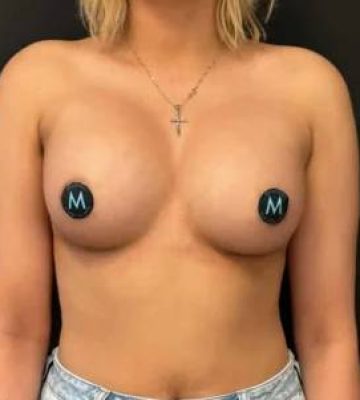 Breast Lift in Georgia at Meadows Surgical Arts