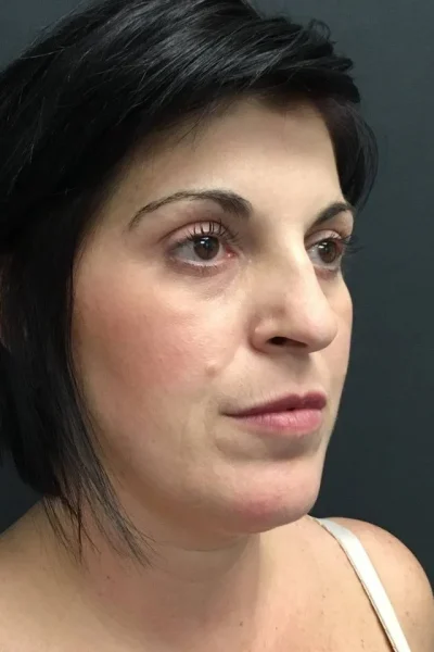 DrDaddyK Signature Neck Lift" with Renuvion in Georgia at Meadows Surgical Arts